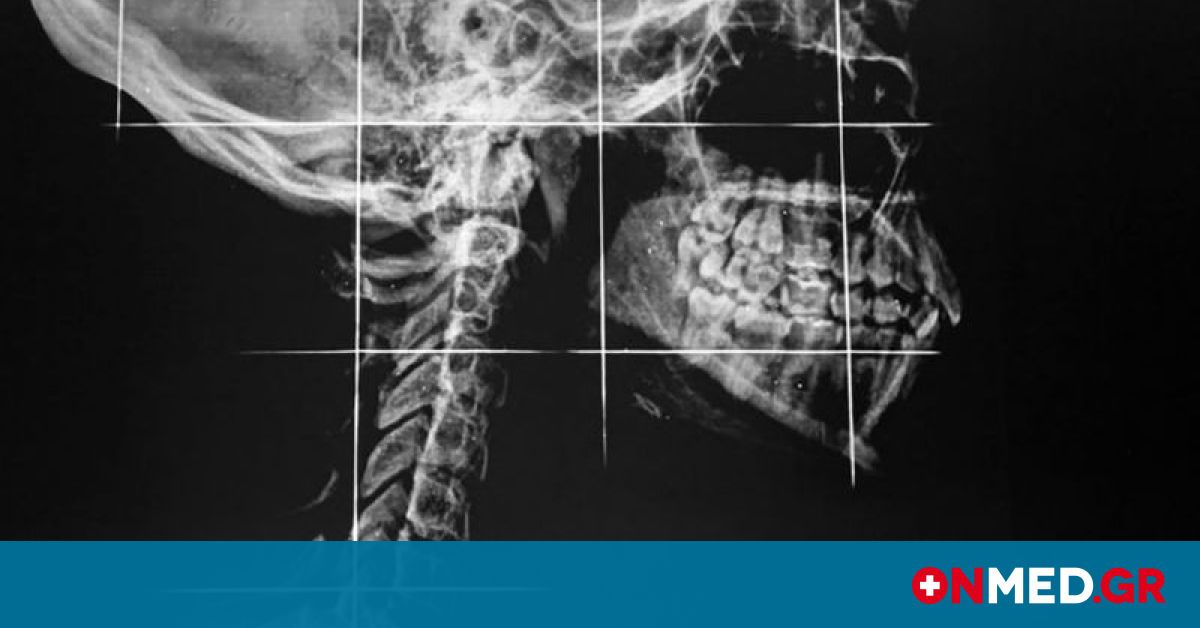 εξασθενημένη γνάθο πριν και μετά Διατροφικό πρόγραμμα για απώλεια βάρους δωρεάν