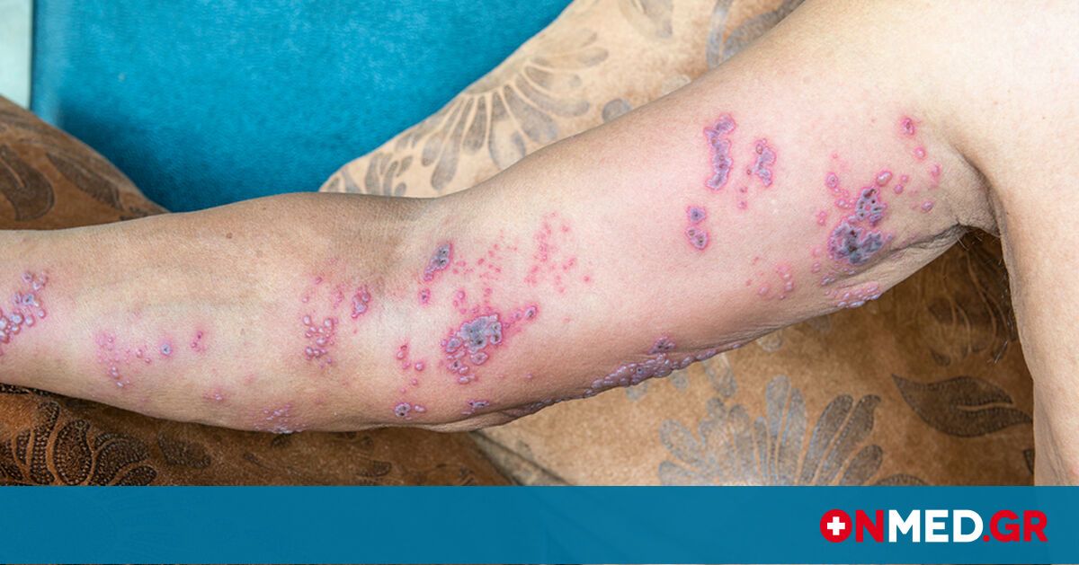 στήθος αδυνατίσματος απώλεια βάρους έναντι απώλειας λίπους