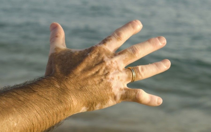 Λεύκη: Θεαματικά αποτελέσματα χάρη σε φάρμακο για τη ρευματοειδή αρθρίτιδα