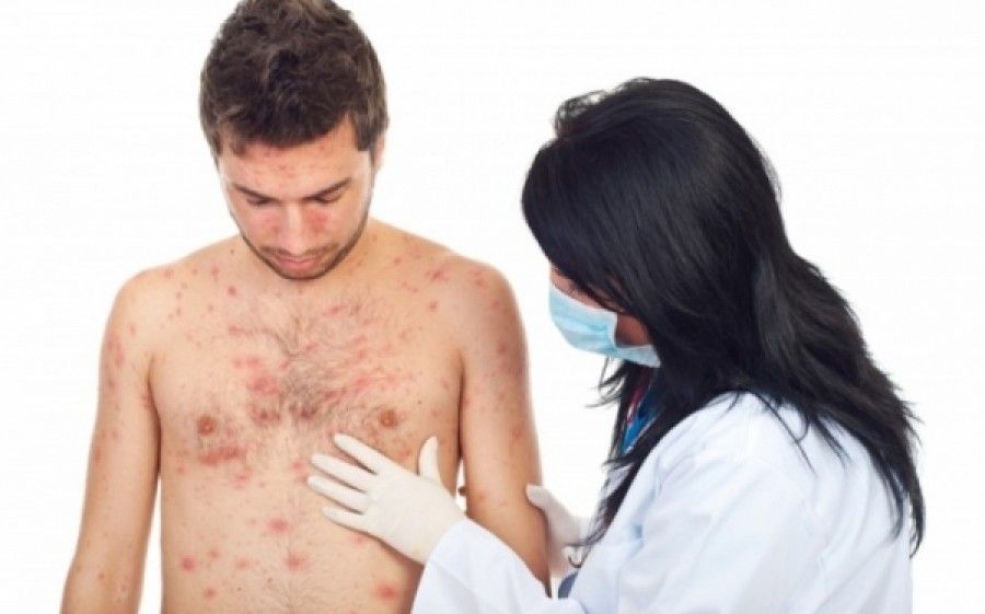 Κρούσματα ανεμοβλογιάς στην Ειδομένη: Νέοι εμβολιασμοί και πιθανή επίσκεψη Ξανθού στον καταυλισμό
