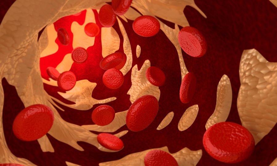 Καρδιαγγειακά: Σκεύασμα της Amgen μειώνει σημαντικά τα επεισόδια, σύμφωνα με μελέτη