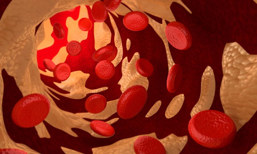 Χοληστερόλη LDL, HDL, VLDL, ολική: Ποιες είναι οι φυσιολογικές τιμές