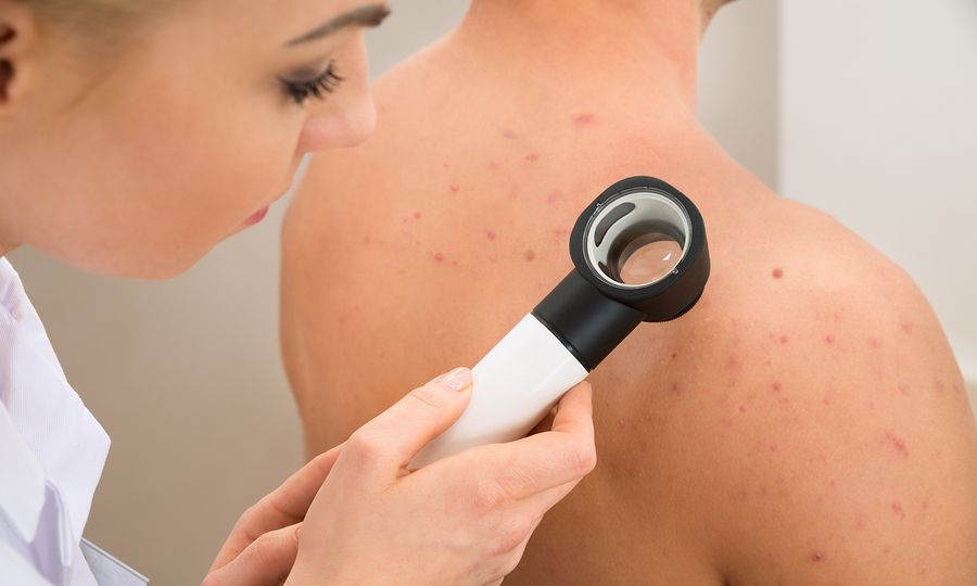 Όμιλος ΥΓΕΙΑ: Προσφορά εξετάσεων για την έγκαιρη διάγνωση του μελανώματος