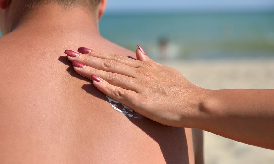 «Βούτυρο για το έγκαυμα» και άλλοι καλοκαιρινοί μύθοι για την υγεία της επιδερμίδας
