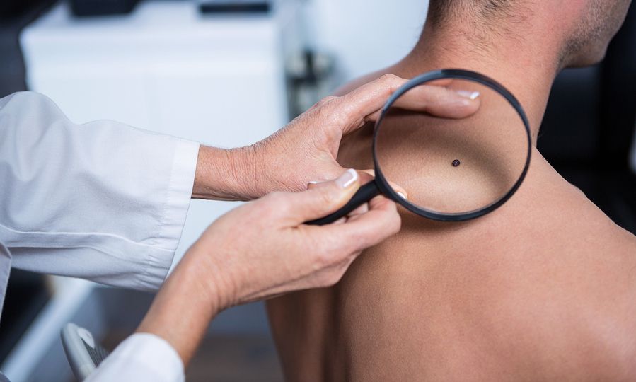 Ελιές & μελάνωμα: Έξι ύποπτες αλλαγές που δεν πρέπει να αγνοήσετε