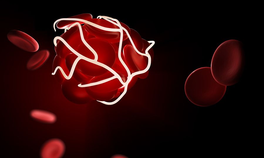 Θρομβοεμβολή: Ποιοι διατρέχουν έως 80% μεγαλύτερο κίνδυνο