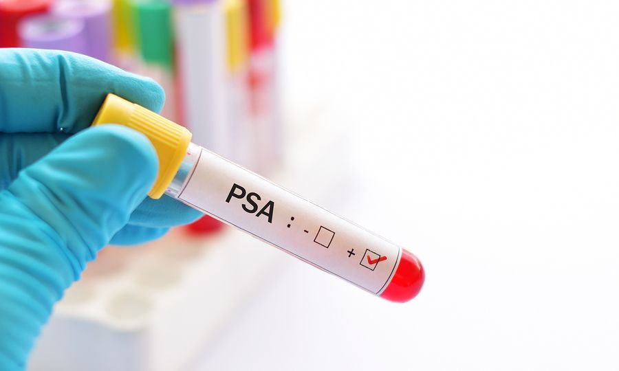 Προστάτης: Τι είναι το PSA και ποιες είναι οι φυσιολογικές τιμές