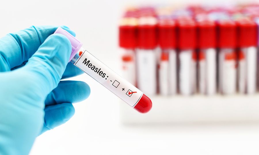 Ιλαρά: Συνεχίζει ακάθεκτη - Σχεδόν 2.000 τα κρούσματα