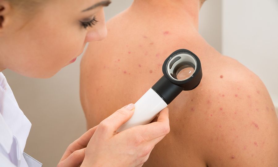 Σπυράκια στο μέτωπο, στο πιγούνι στην πλάτη – Τι δείχνουν σε κάθε περίπτωση