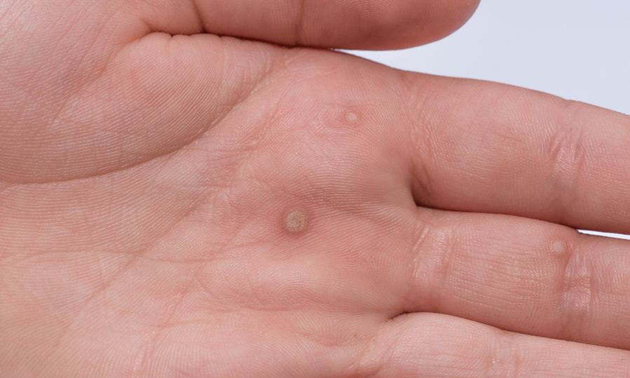 Κονδυλώματα: Μεταδίδεται ο ιός HPV με τα χέρια;