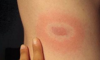 Νόσος Lyme: Πάνω από το 14% του παγκόσμιου πληθυσμού νοσεί