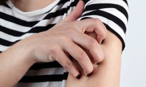 5 εύκολες θεραπείες για το έκζεμα που μπορούν να ανακουφίσουν τη φαγούρα, το ξηρό ή κόκκινο δέρμα