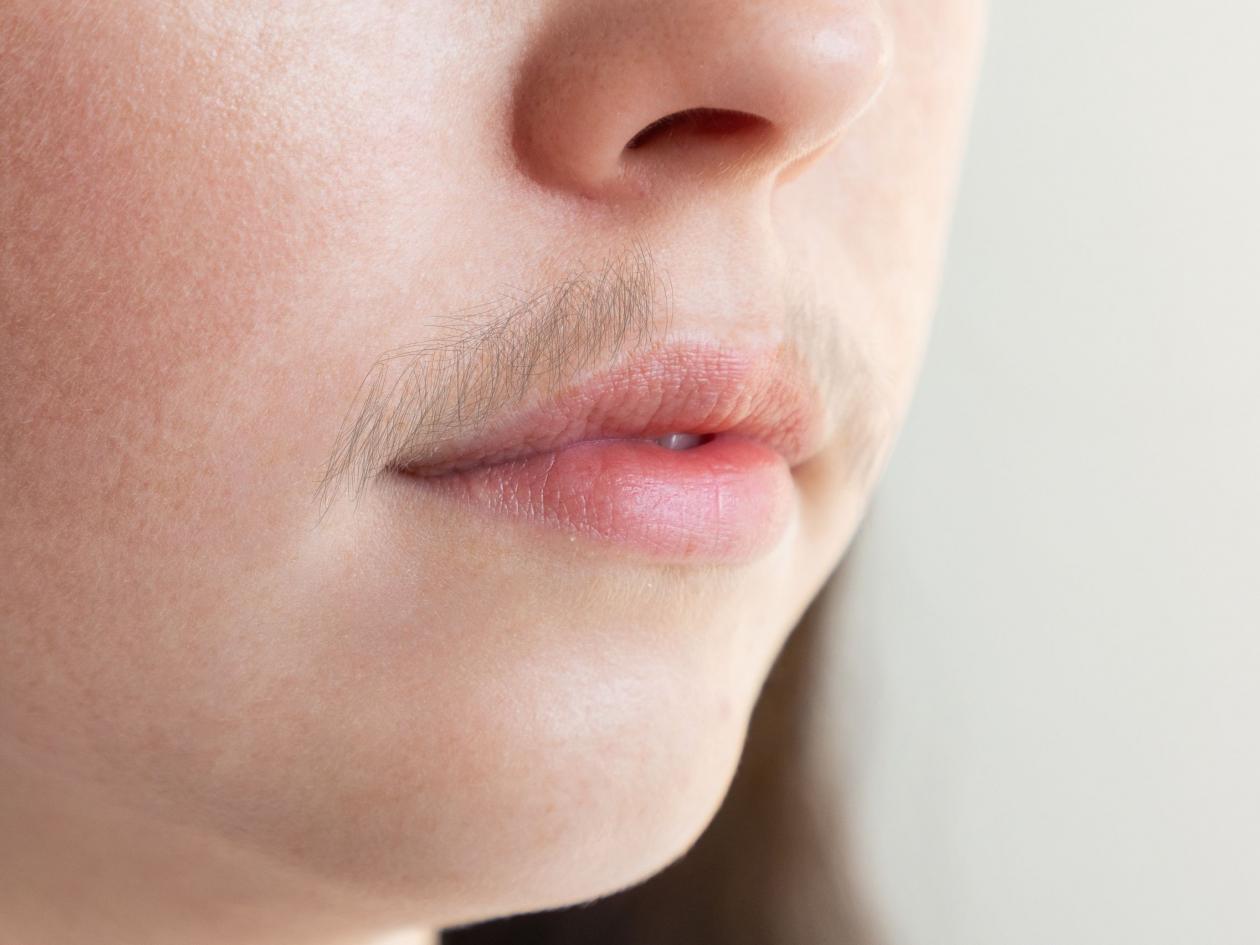 A Close-up Of Caucasian Woman's Face With A Mustache Over Her Upper Lip. The Concept Of Hair Removal