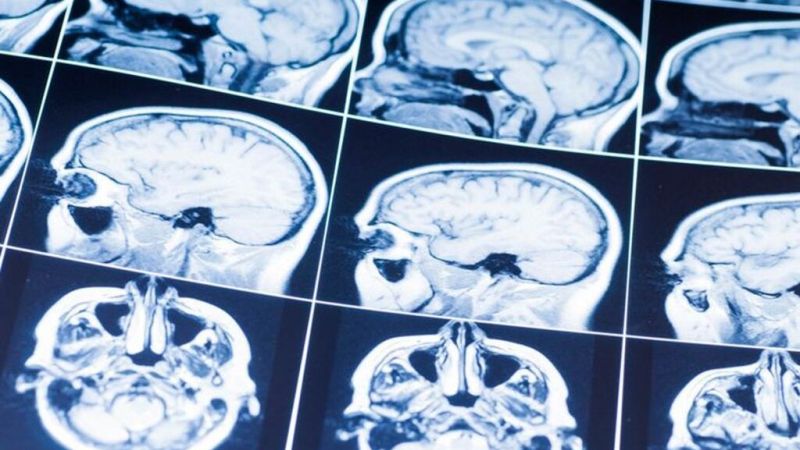 Εγκεφαλικοί όγκοι: Πανευρωπαϊκή μελέτη με ελληνική σφραγίδα για εξέταση ακριβείας εκτός χειρουργείου