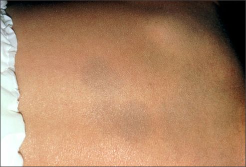 PRinc photo of mongolian spots