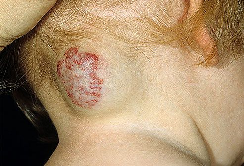 dermnet photo of cavernous hemangioma
