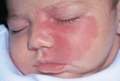 mh photo of port-wine stain on infant