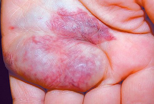 mh photo of venous malformation on hand