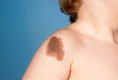 phototake photo of congenital nevus