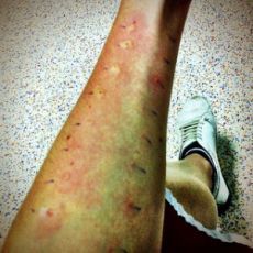 3derma