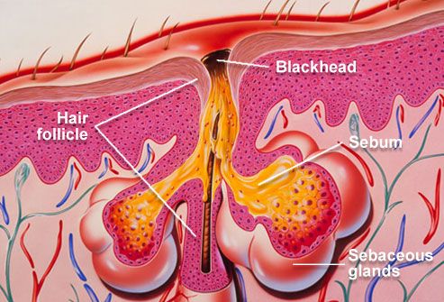 PRInc rm photo of acne diagram