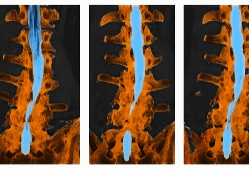 princ rm photo of ct scan of spine