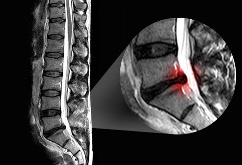 princ rm photo of slipped disc