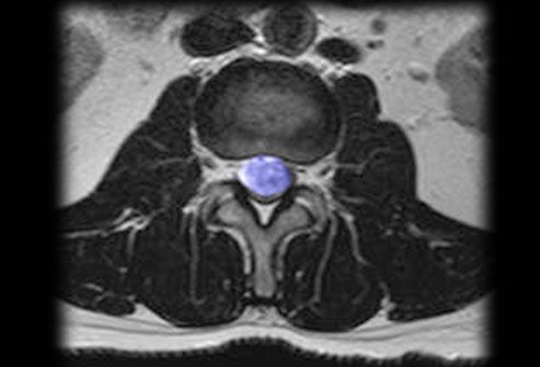 princ rm photo of spinal tumor
