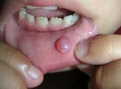lip5