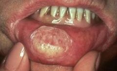 lip7