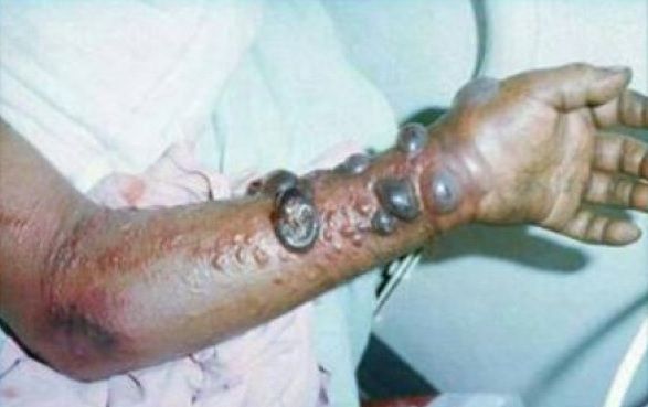 ebola1