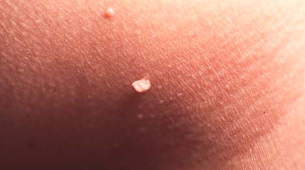 skin tag