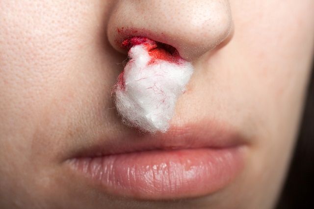 bigstock Nosebleed 7426400
