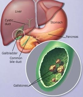 gallstones