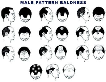 male pattern baldness
