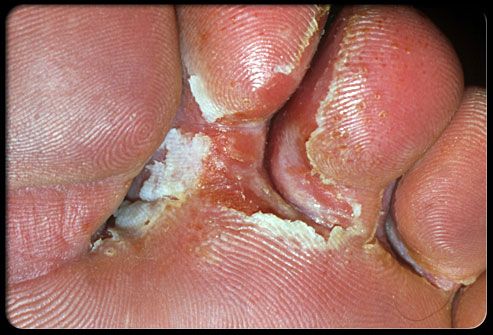 Athletes Foot
