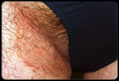 Jock Itch