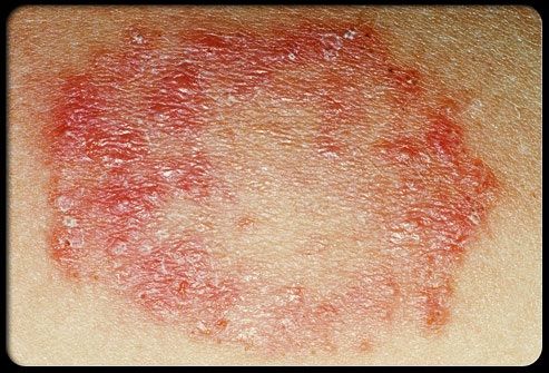 Ringworm
