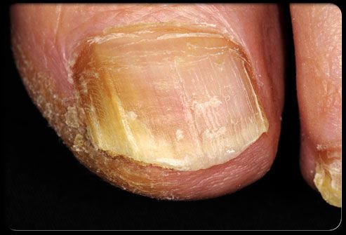 nail fungus