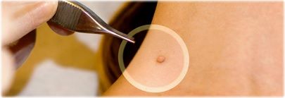 skin tag