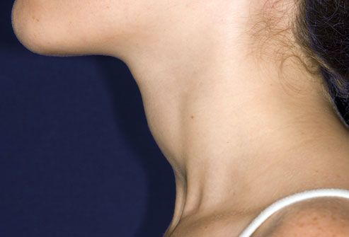 12princ rm photo of swollen thyroid