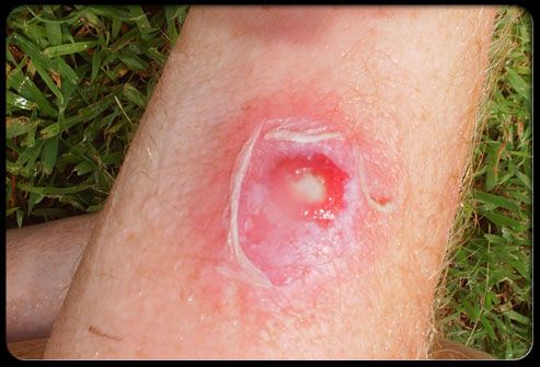 201staph-infection-s4-photo-of-staph-infection