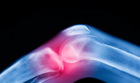 Knee osteoarthritis