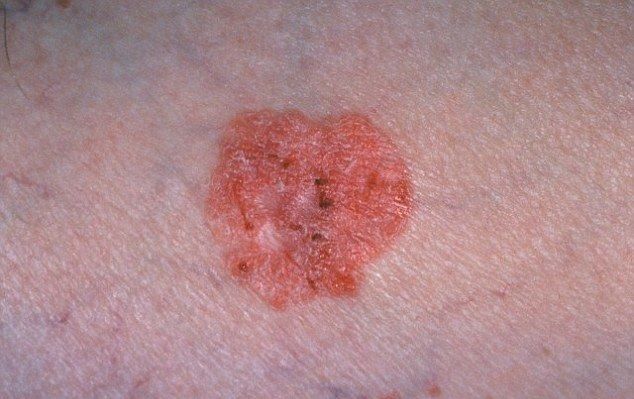 2squamous