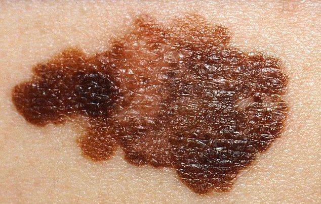 3melanoma