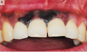 mouthcan1