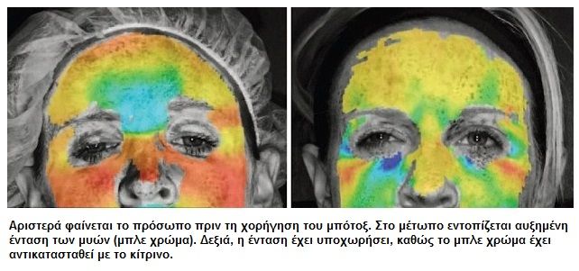 botox1