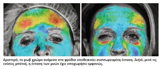 botox2
