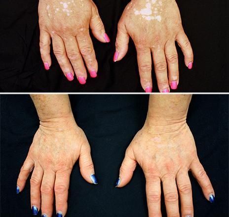 Vitiligo