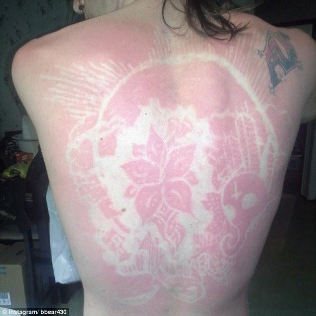 sunburn art 1